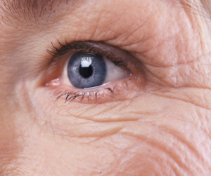 Excess wrinkles and loss of collagen integrity are obvious examples of a lack of estrogen.