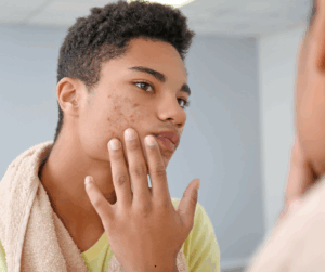 Do I need a Parasite Cleanse? 4 Acne on the cheeks or forehead is a common sign of parasites.